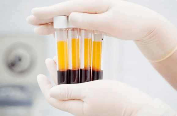 PRP therapy