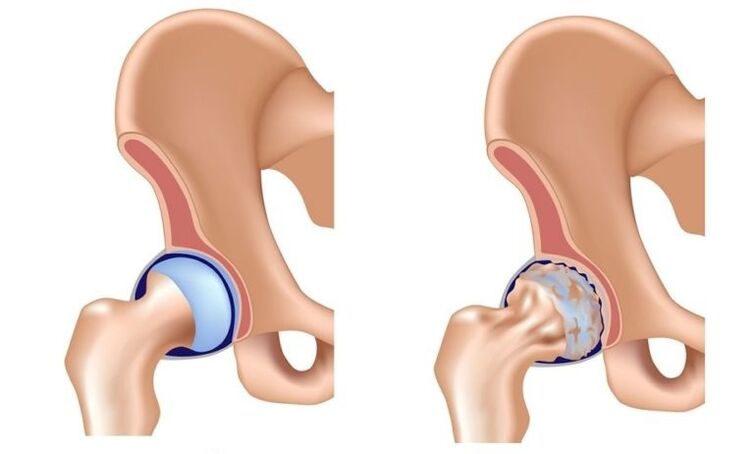 Healthy articulation and arthrosis articulation