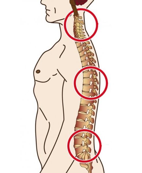 Column departments in which osteochondrosis occurs