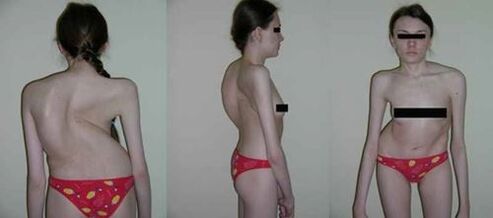 Curvature of the column as a consequence of osteochondrosis