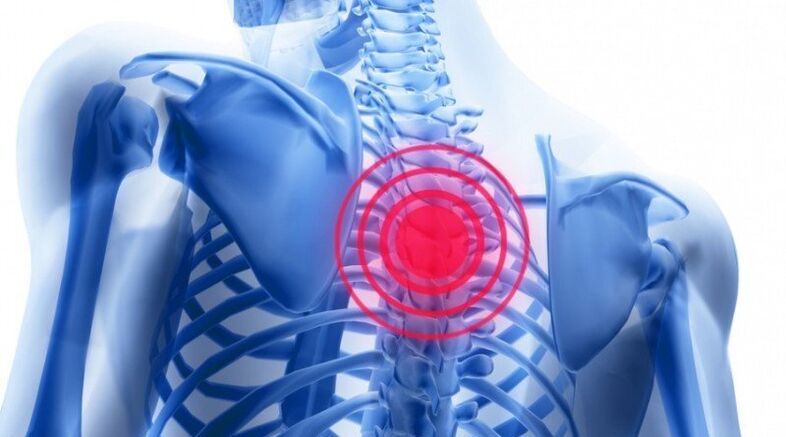 Back pain can be caused by a herniated disc.